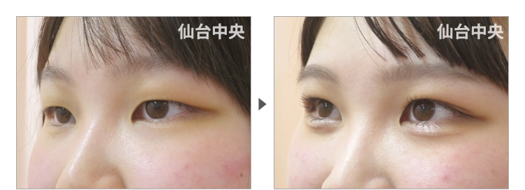 20歳、女性。埋没法によるパッチリ目 症例写真3