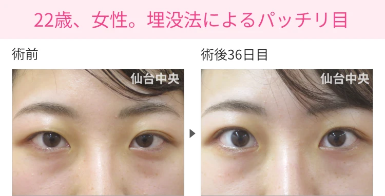 22歳、女性。埋没法によるパッチリ目 症例写真1