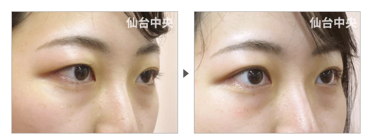 22歳、女性。埋没法によるパッチリ目 症例写真2