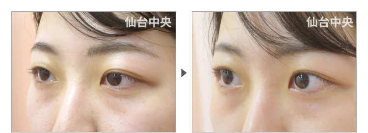22歳、女性。埋没法によるパッチリ目 症例写真3