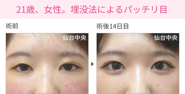 21歳、女性。埋没法によるパッチリ目 症例写真1