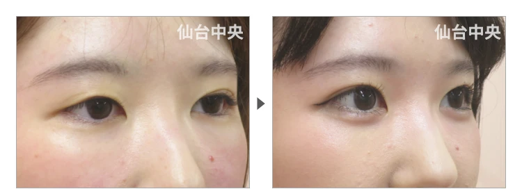 21歳、女性。埋没法によるパッチリ目 症例写真2