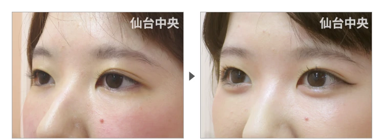 21歳、女性。埋没法によるパッチリ目 症例写真3