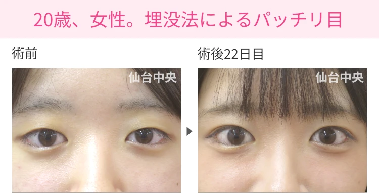 20歳、女性。埋没法によるパッチリ目 症例写真1