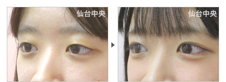 20歳、女性。埋没法によるパッチリ目 症例写真3