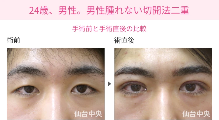 24歳、男性。男性腫れない切開法二重、術前と術直後の比較 症例写真1