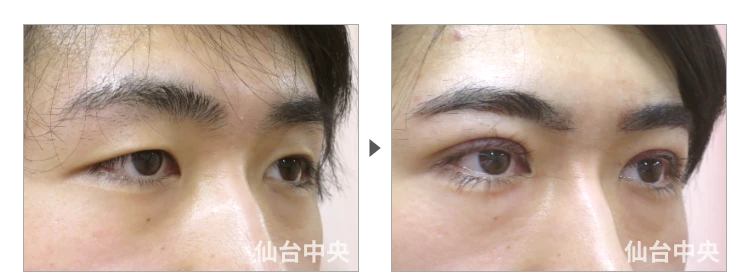 24歳、男性。男性腫れない切開法二重、術前と術直後の比較 症例写真2