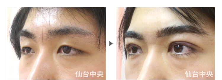 24歳、男性。男性腫れない切開法二重、術前と術直後の比較 症例写真3