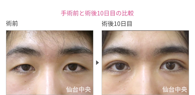 24歳、男性。男性腫れない切開法二重、術前と術後10日目の比較 症例写真4