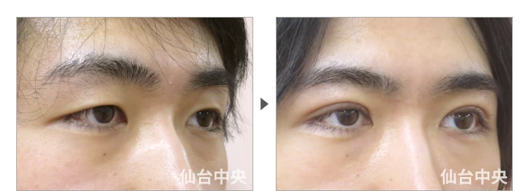 24歳、男性。男性腫れない切開法二重、術前と術後10日目の比較 症例写真5