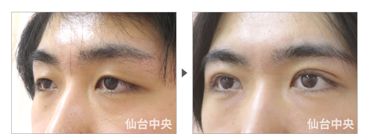 24歳、男性。男性腫れない切開法二重、術前と術後10日目の比較 症例写真6