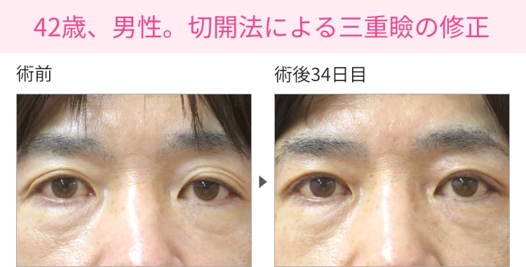 42歳、男性。切開法による三重瞼の修正 症例写真1