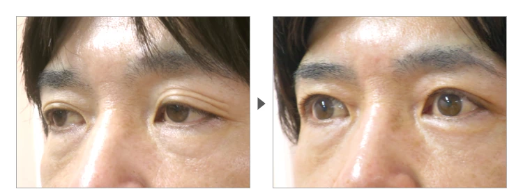 42歳、男性。切開法による三重瞼の修正 症例写真3