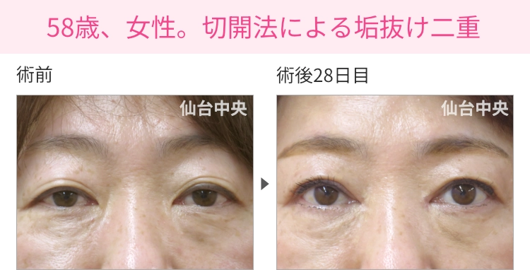 58歳、女性。切開法による垢抜け二重の症例写真 症例写真1