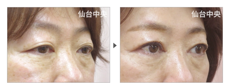 58歳、女性。切開法による垢抜け二重の症例写真 症例写真2