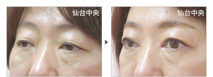 58歳、女性。切開法による垢抜け二重の症例写真 症例写真3