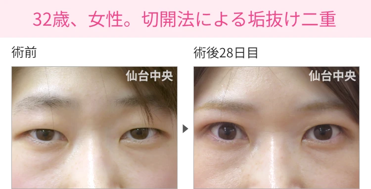 32歳、女性。切開法による垢抜け二重の症例写真 症例写真1