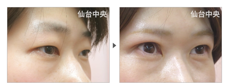 32歳、女性。切開法による垢抜け二重の症例写真 症例写真2