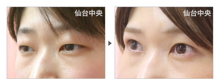32歳、女性。切開法による垢抜け二重の症例写真 症例写真3