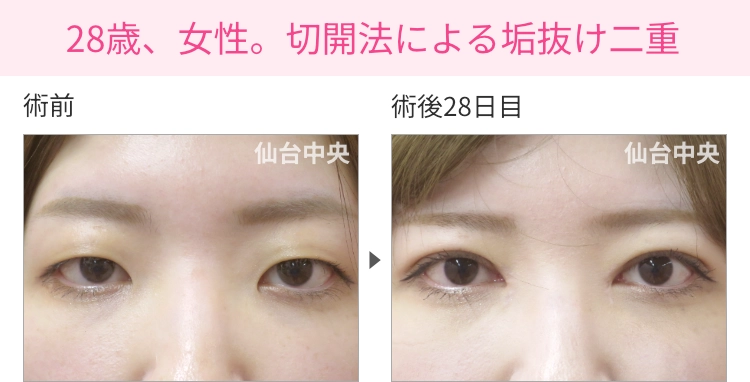 28歳、女性。切開法による垢抜け二重の症例写真 症例写真1