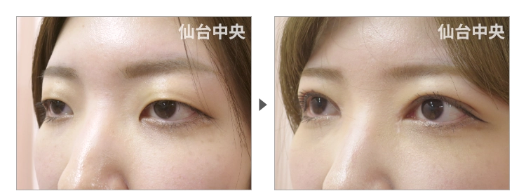 28歳、女性。切開法による垢抜け二重の症例写真 症例写真3