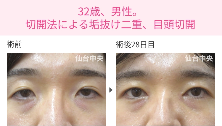 32歳、男性。切開法による垢抜け二重、目頭切開の症例写真 症例写真1