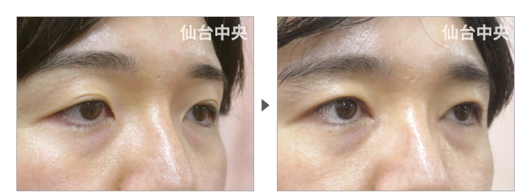 32歳、男性。切開法による垢抜け二重、目頭切開の症例写真 症例写真2