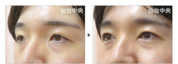 32歳、男性。切開法による垢抜け二重、目頭切開の症例写真 症例写真3