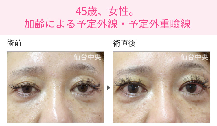 45歳、女性。加齢による予定外線・予定外重瞼線 症例写真1