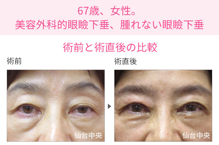 67歳、女性。美容外科的眼瞼下垂、腫れない眼瞼下垂 症例写真1