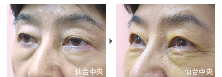 67歳、女性。美容外科的眼瞼下垂、腫れない眼瞼下垂 症例写真6