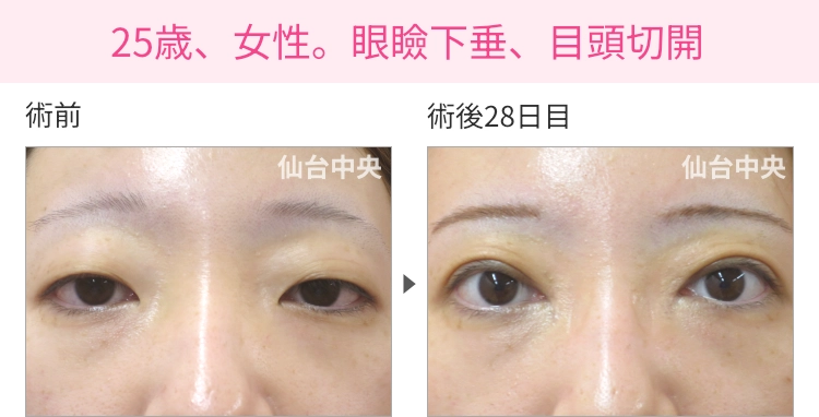 25歳、女性。眼瞼下垂、目頭切開の症例写真 症例写真1