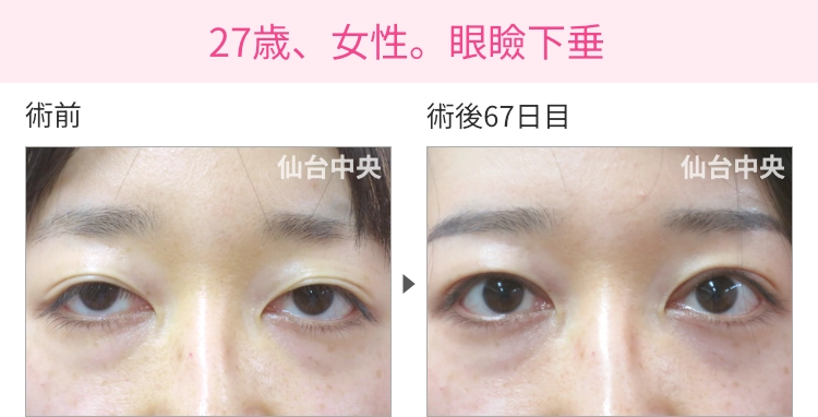 27歳、女性。眼瞼下垂の症例写真 症例写真1