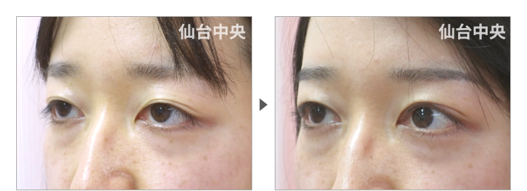 27歳、女性。眼瞼下垂の症例写真 症例写真3