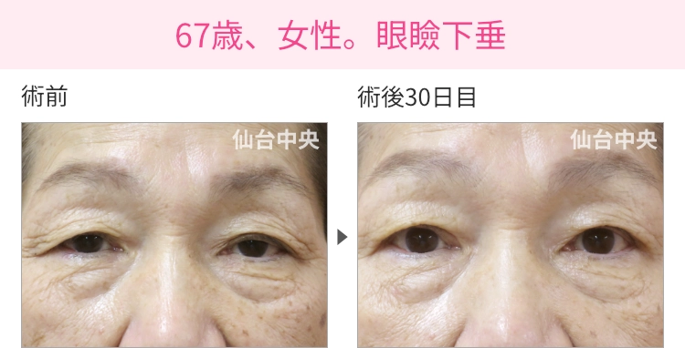 67歳、女性。眼瞼下垂の症例写真 症例写真1