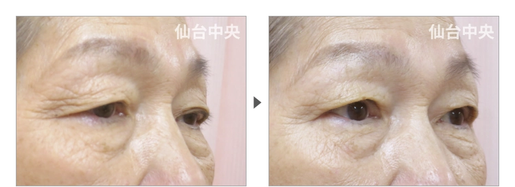 67歳、女性。眼瞼下垂の症例写真 症例写真2