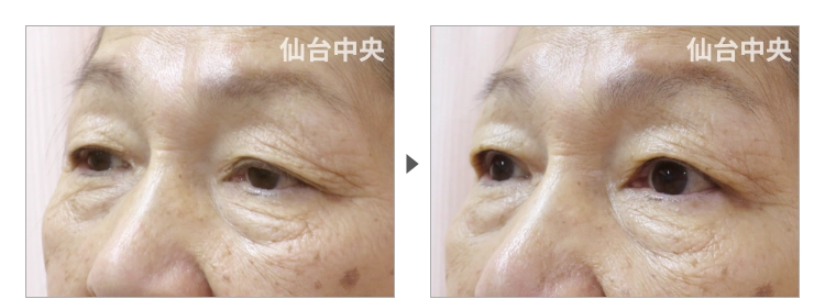 67歳、女性。眼瞼下垂の症例写真 症例写真3