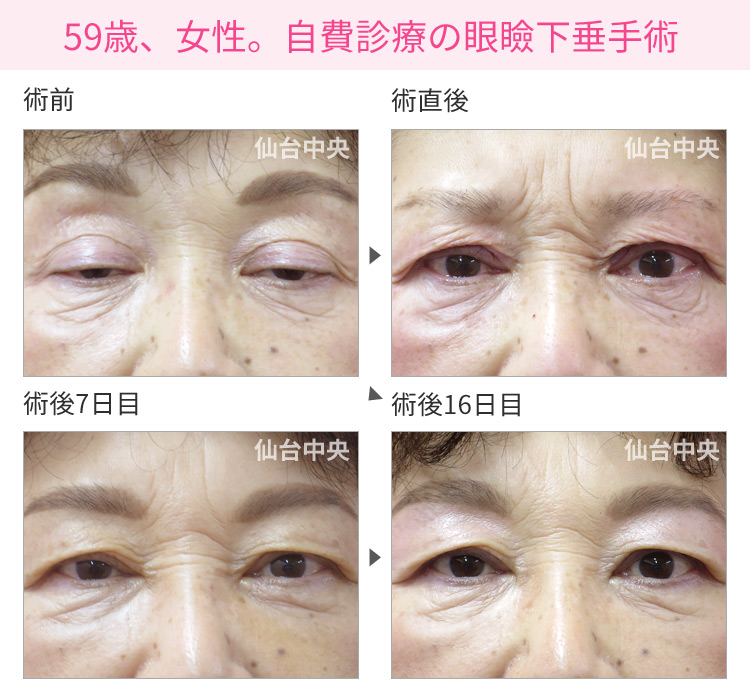 59歳、女性。自費診療の眼瞼下垂手術。術前から術後16日までの経過 症例写真1