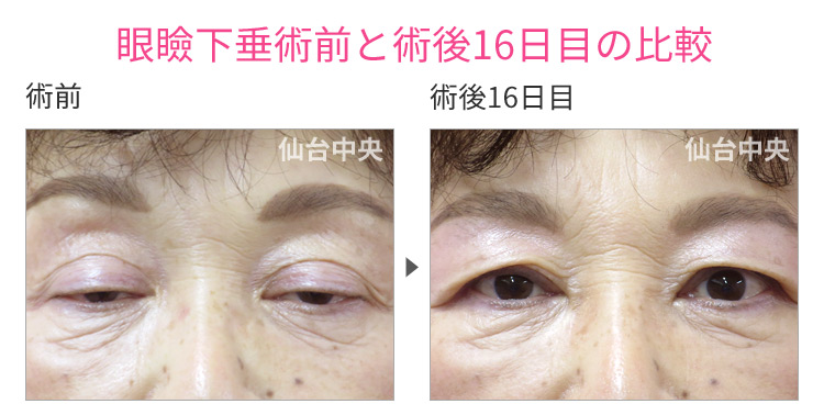 59歳、女性。自費診療の眼瞼下垂手術。眼瞼下垂術前と術後16日目の比較 症例写真2