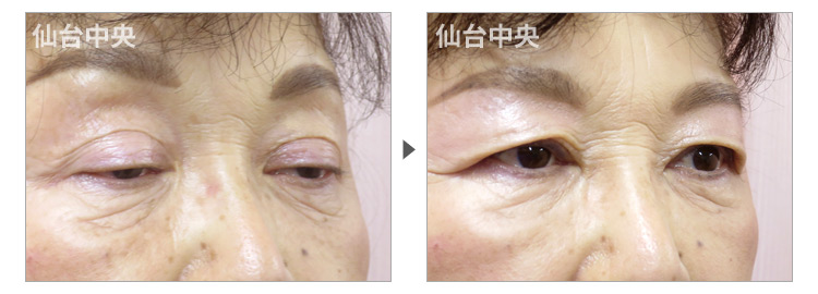 59歳、女性。自費診療の眼瞼下垂手術。眼瞼下垂術前と術後16日目の比較 症例写真3
