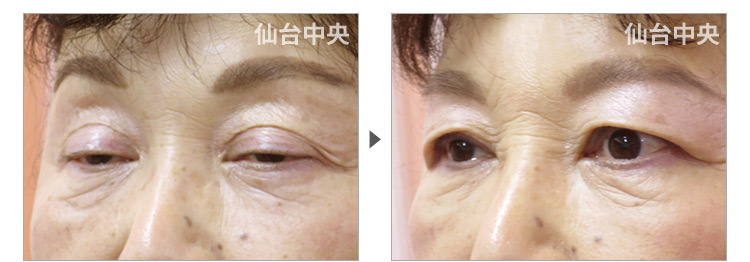 59歳、女性。自費診療の眼瞼下垂手術。眼瞼下垂術前と術後16日目の比較 症例写真4