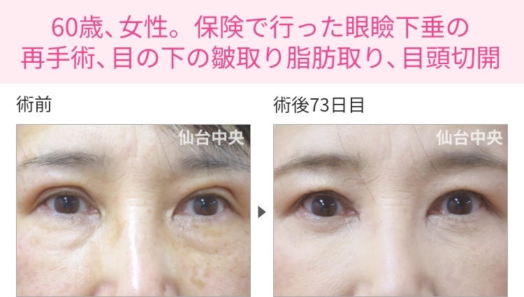 60歳、女性。保険で行った眼瞼下垂の再手術、目の下の皺取り脂肪取り、目頭切開の症例写真 症例写真1