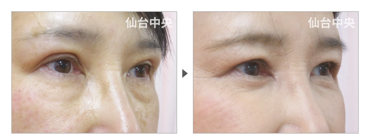 60歳、女性。保険で行った眼瞼下垂の再手術、目の下の皺取り脂肪取り、目頭切開の症例写真 症例写真2