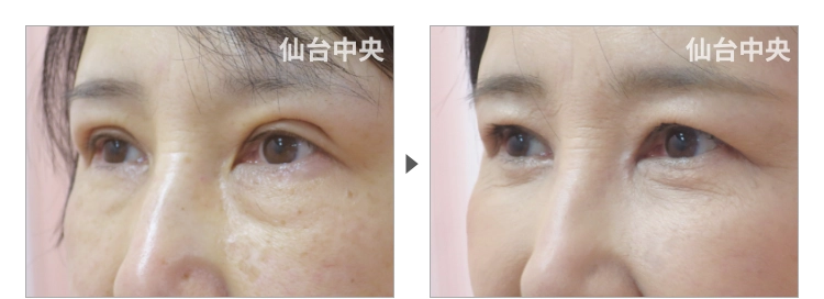 60歳、女性。保険で行った眼瞼下垂の再手術、目の下の皺取り脂肪取り、目頭切開の症例写真 症例写真3