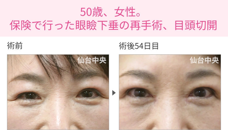 50歳、女性。保険で行った眼瞼下垂の再手術、目頭切開 症例写真1