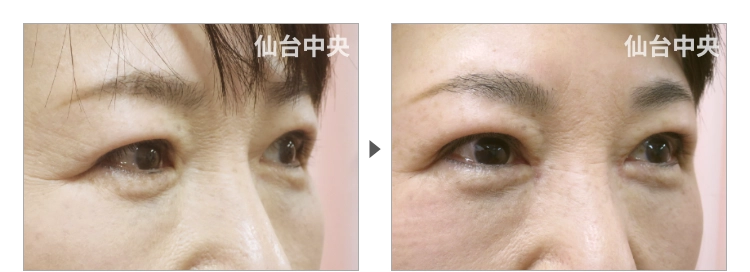 50歳、女性。保険で行った眼瞼下垂の再手術、目頭切開 症例写真2