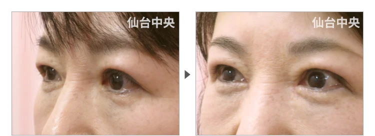 50歳、女性。保険で行った眼瞼下垂の再手術、目頭切開 症例写真3