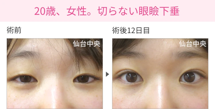 20歳、女性。切らない眼瞼下垂 症例写真1