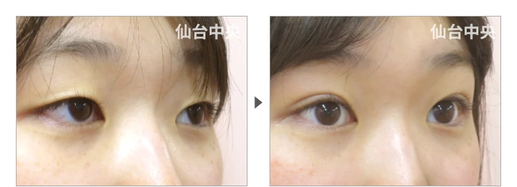 20歳、女性。切らない眼瞼下垂 症例写真2