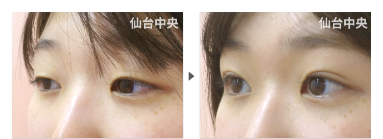 20歳、女性。切らない眼瞼下垂 症例写真3